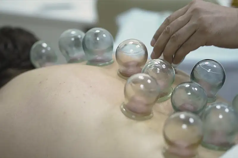 What is Cupping therapy in North Dallas