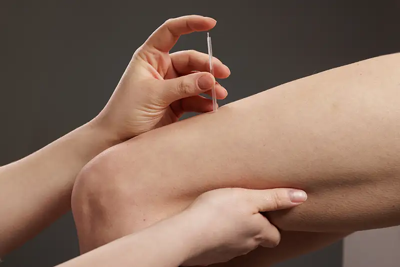 What is Dry Needling in North Dallas