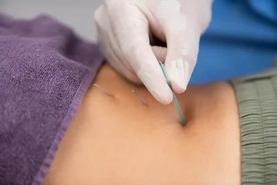 Dry Needling in North Dallas